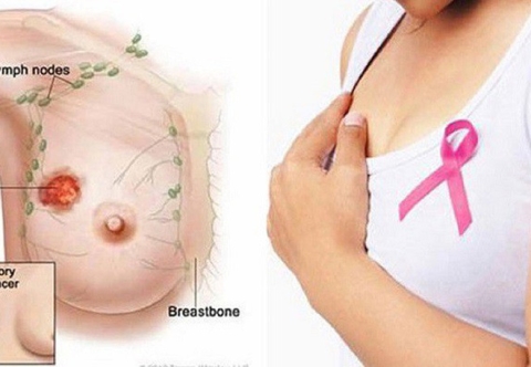 Béo phì và nguy cơ ung thư vú